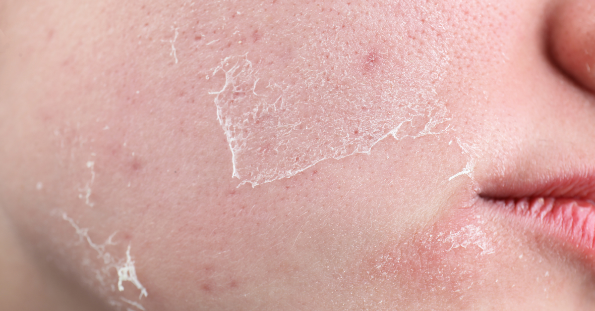 Piel seca en la rutina skincare