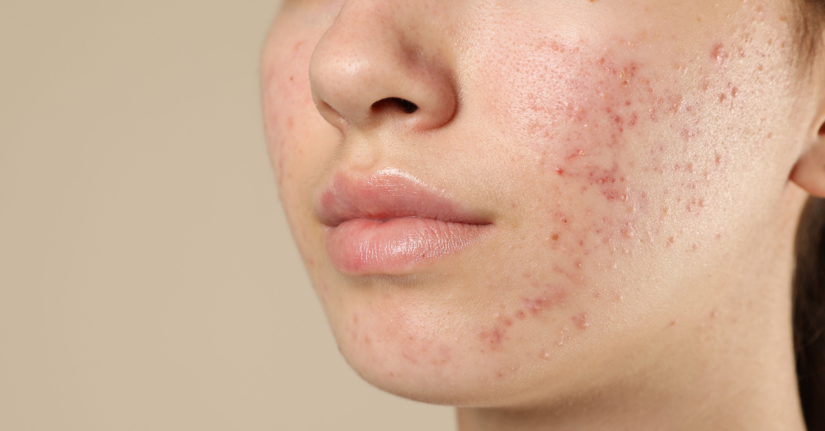 Irritación y lesiones en la piel en la rutina skincare