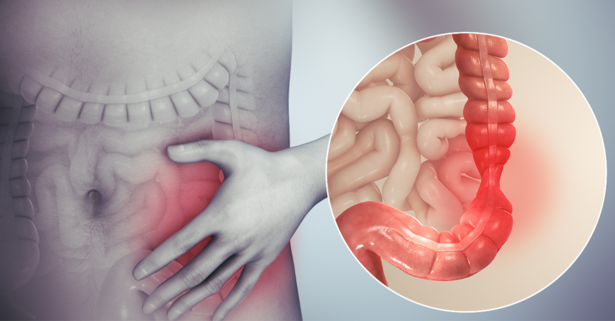 Síndrome del intestino irritable en una dieta rica en fibra